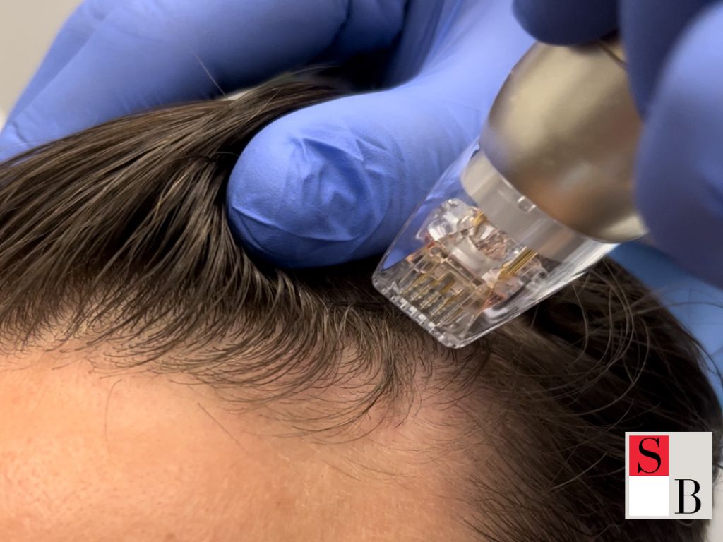 Professional Postpartum Hair Loss Treatments at Wellaholic Singapore