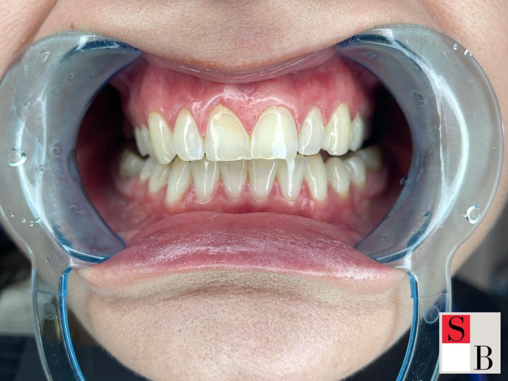 Understanding DIY Teeth Whitening in Singapore