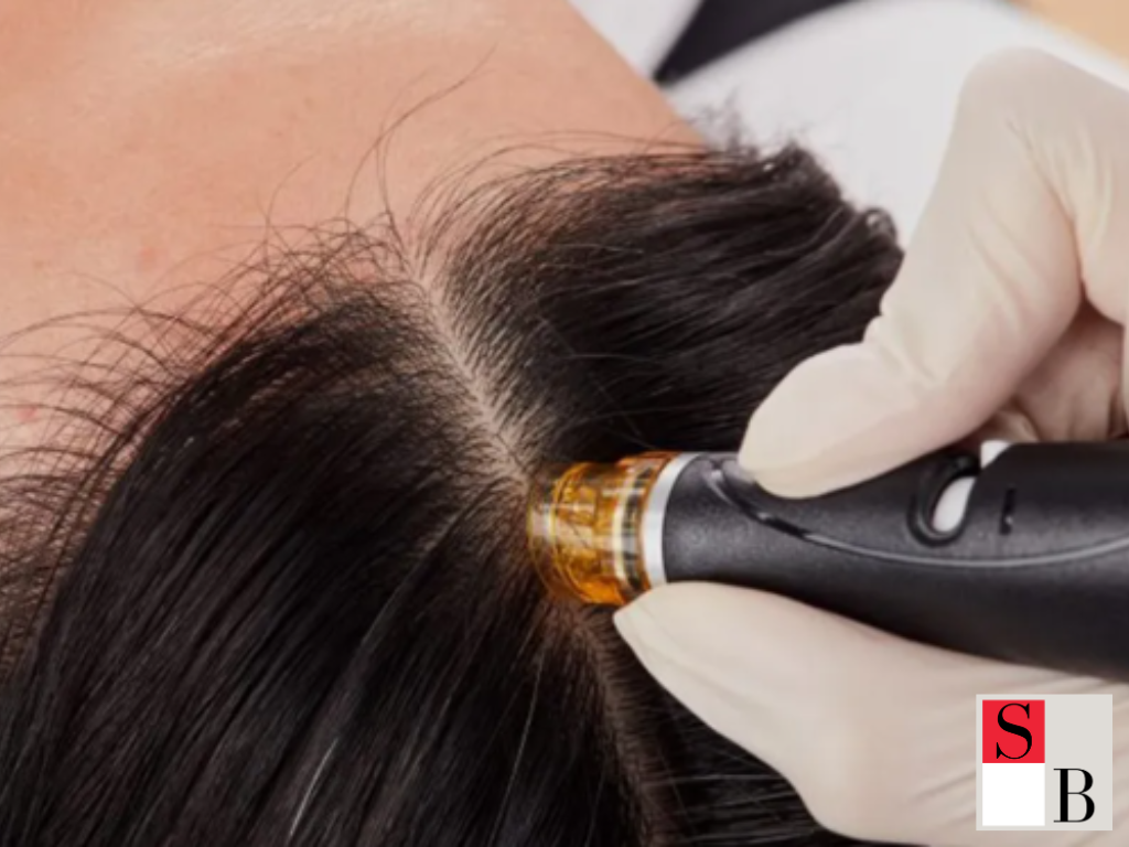 Benefits of Early Hair Loss Treatment in Singapore