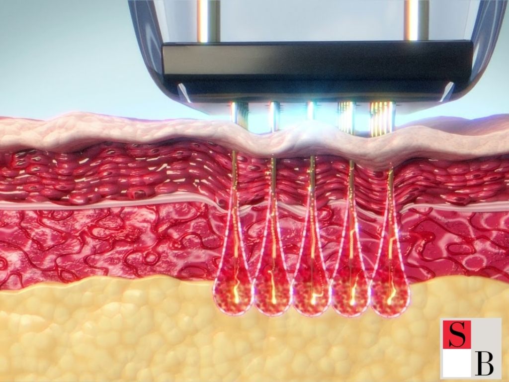 What is RF Microneedling?