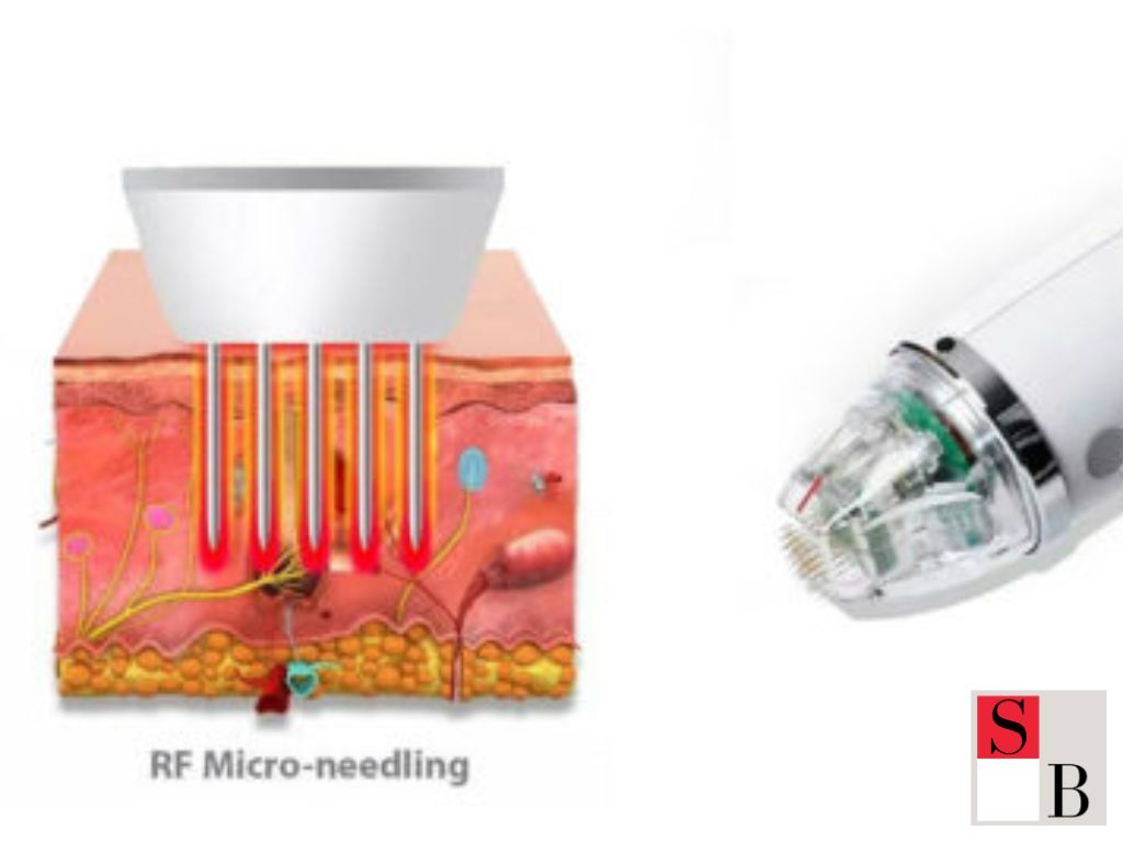 What is RF Microneedling and How Does It Work?