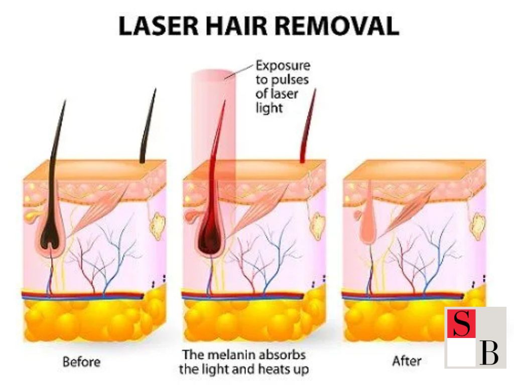 What is Laser Hair Removal in Singapore?
