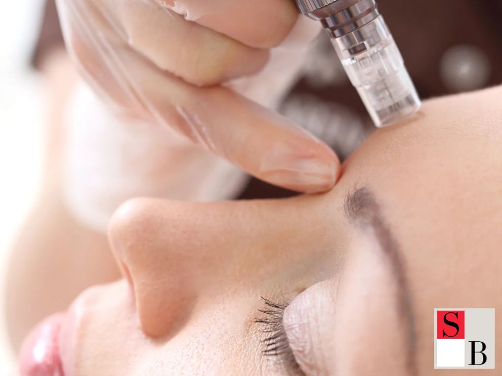 Why Professional Microneedling Beats DIY in Singapore