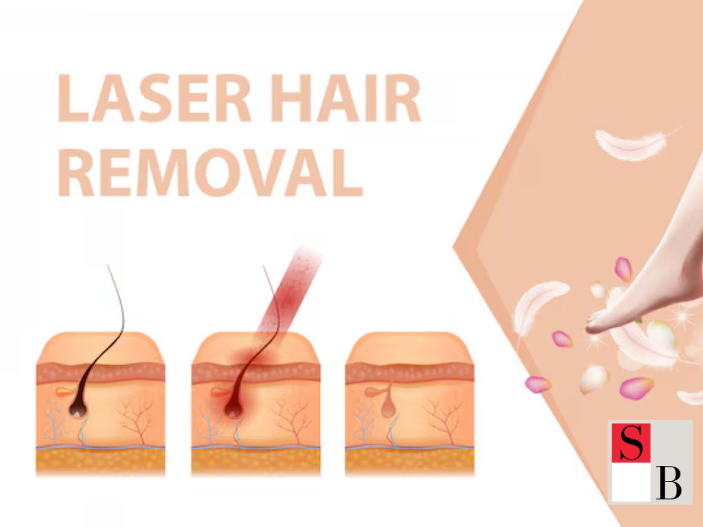 Benefits of Laser Hair Removal in Singapore