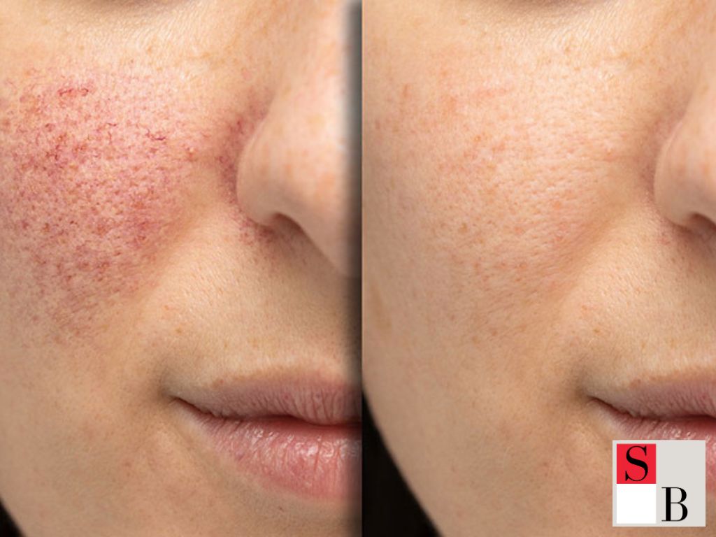 Key Benefits of IPL Facials for Singapore Women