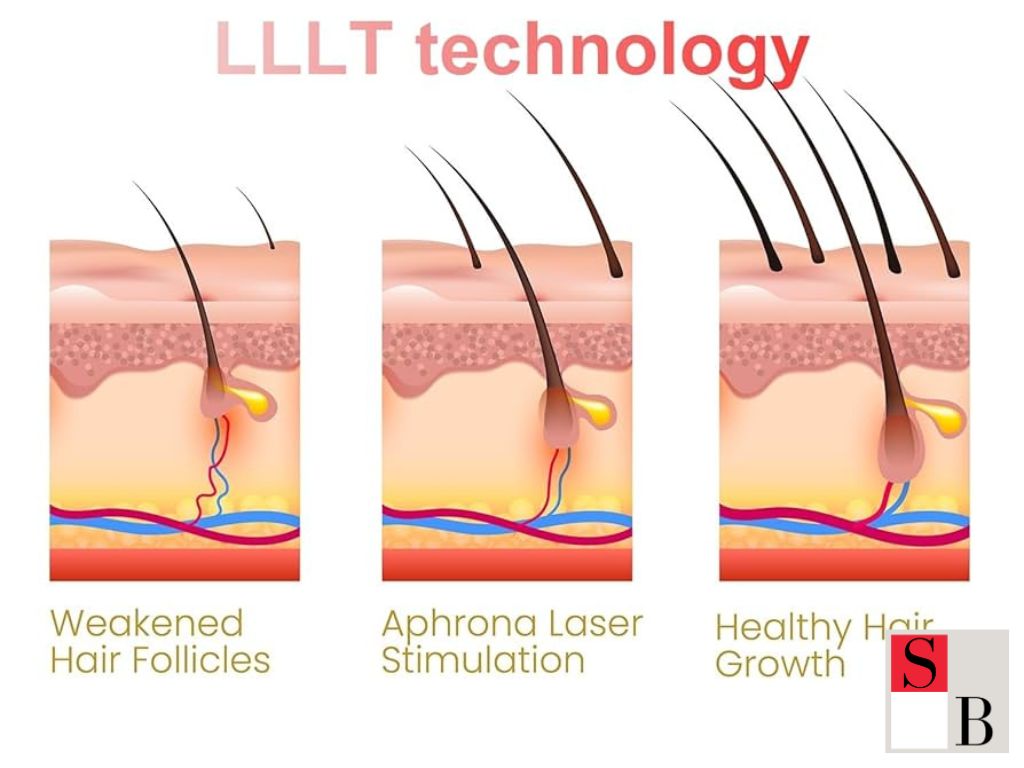 Advantages of Laser Therapy for Young Adults