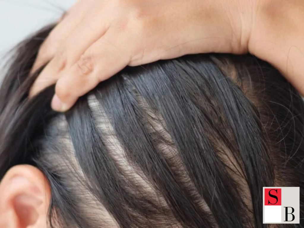 Early Hair Loss Causes in Young Singaporeans