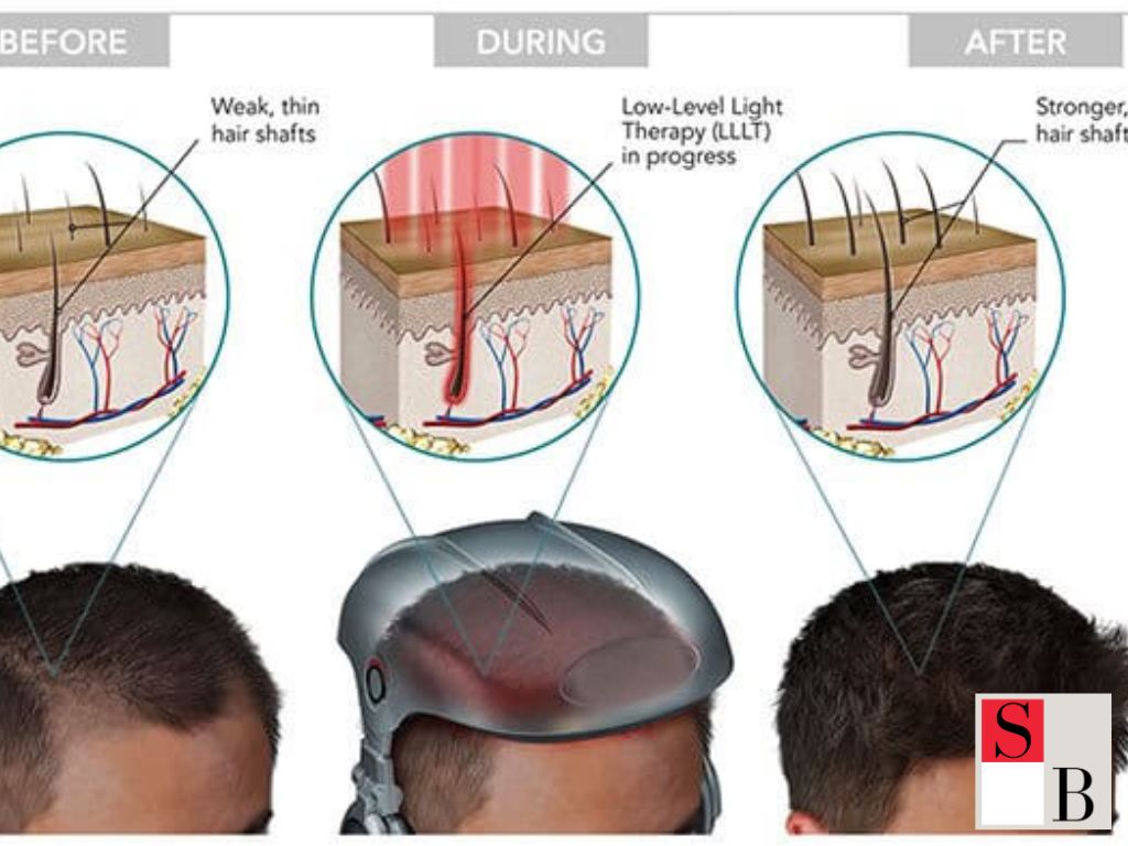 Practical Steps to Begin Laser Hair Therapy