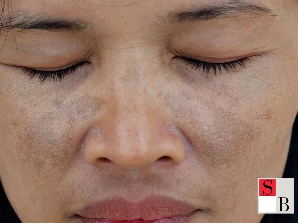 Practical Ways to Treat Dark Spots at Home in Singapore