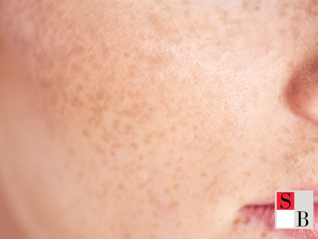 What Causes Dark Spots on Asian Skin