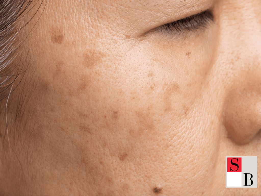 Why Targeted Pigmentation Treatments Work Best for Asian Skin
