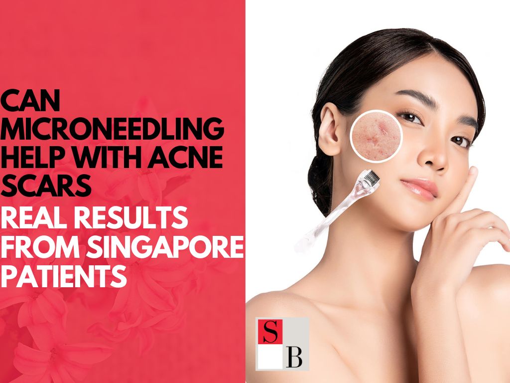 Can Microneedling Help with Acne Scars? Real Results from Singapore Patients