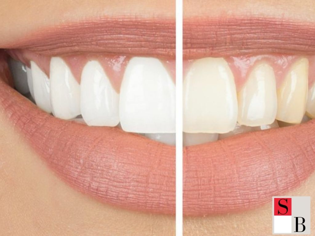 Why Singaporeans Choose LED Teeth Whitening