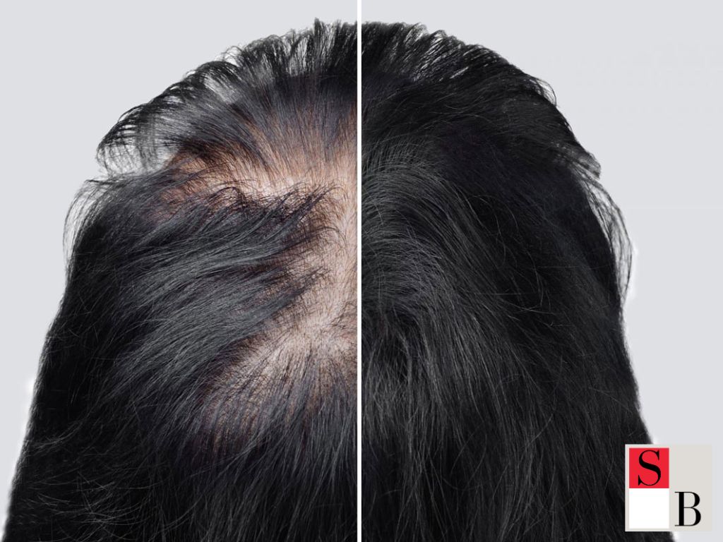 What is Hair Restoration in Somerset?