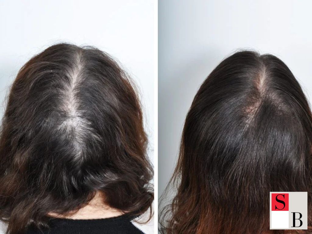 Key Benefits of Hair Restoration in Singapore
