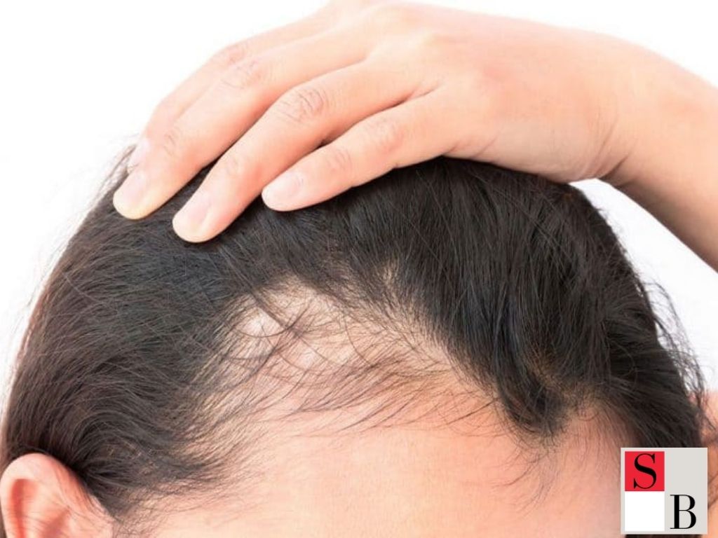 Why Hair Thinning After 40 Affects Asian Women in Singapore