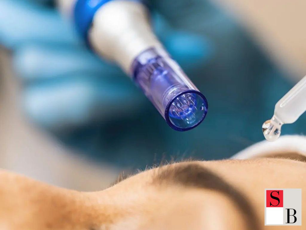 Understanding Microneedling: Core Concepts for Singapore Skin