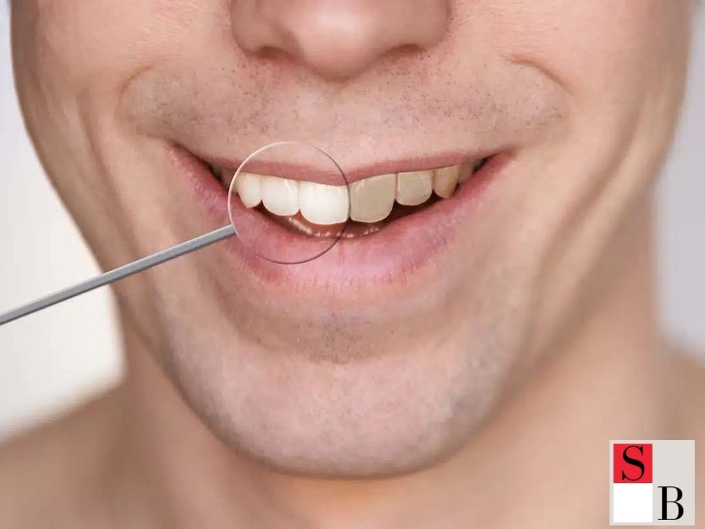 How to Whiten Teeth at Home in Singapore