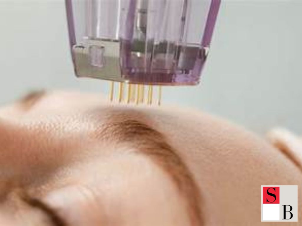 How to Safely Add Microneedling to Your Skincare Routine in Singapore