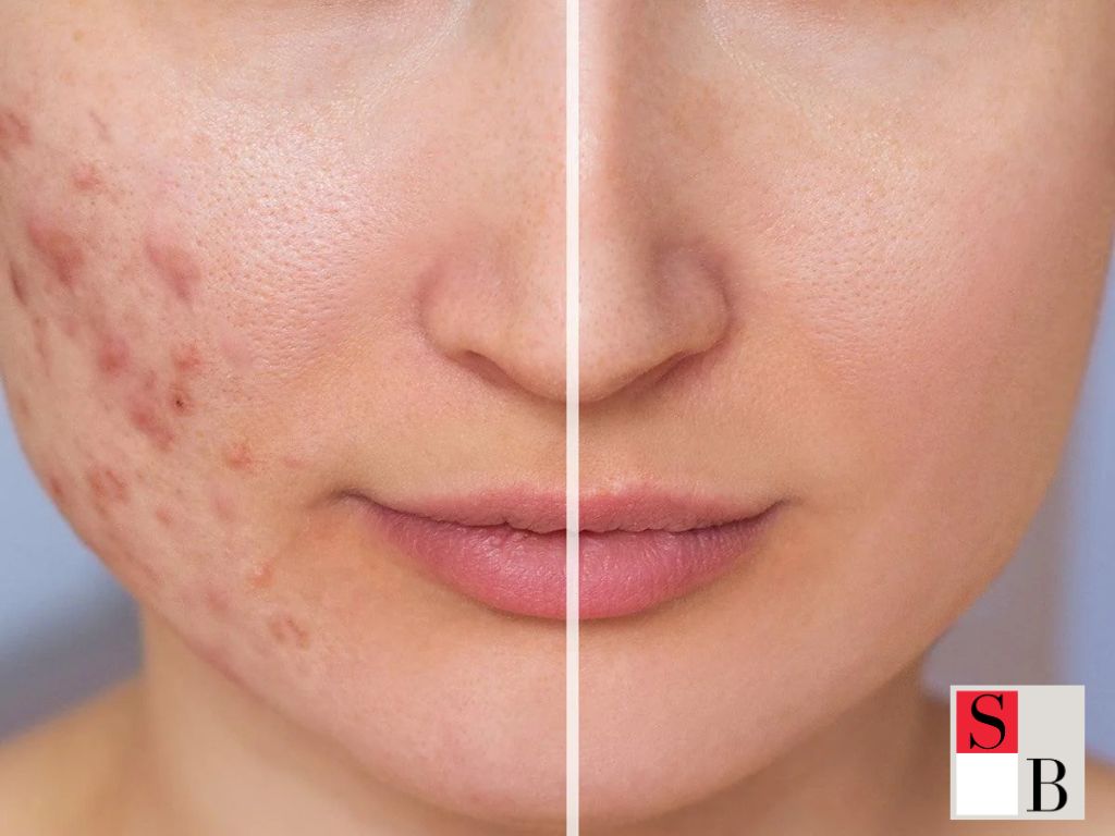 Key Benefits of Microneedling for Singaporean Skin