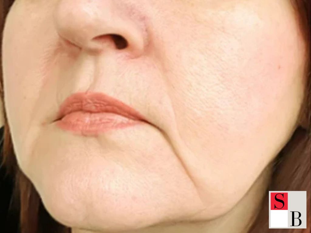 Why Microneedling Is the Gold Standard for Skin Rejuvenation in Singapore