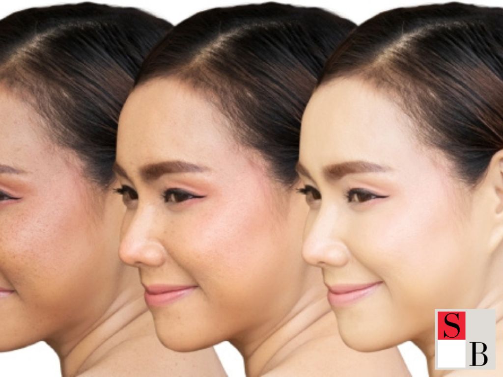 Why Laser Therapy Is Gaining Ground in Singapore’s Skincare Scene
