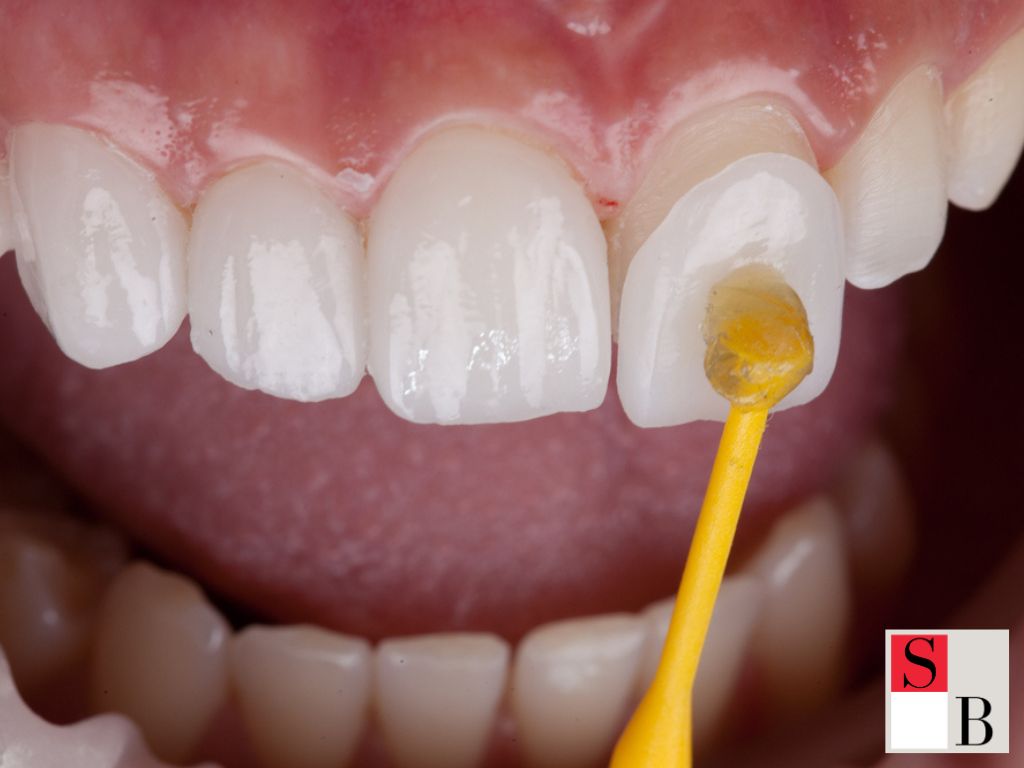 How to Choose Between Porcelain and Ceramic Veneers in Singapore