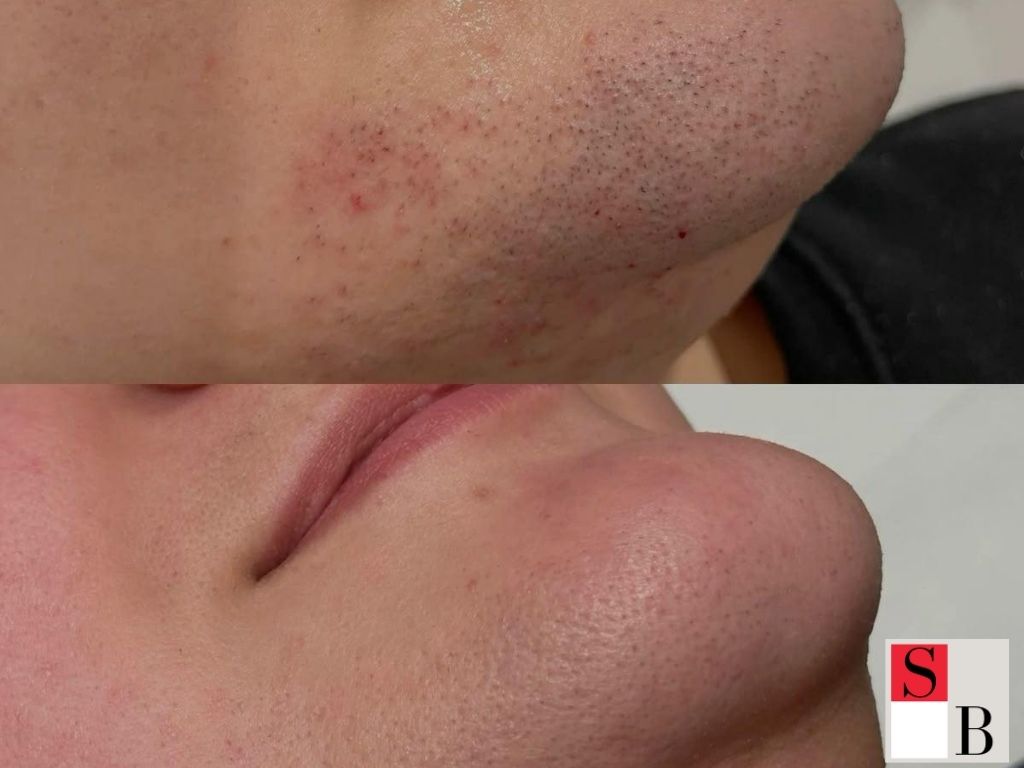Key Benefits of Professional Male Hair Removal in Singapore