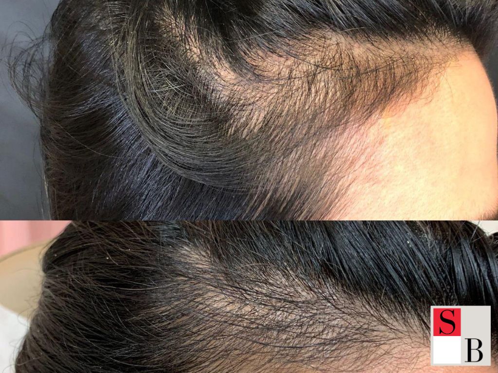 Practical Hair Regrowth Solutions for Singapore Executives