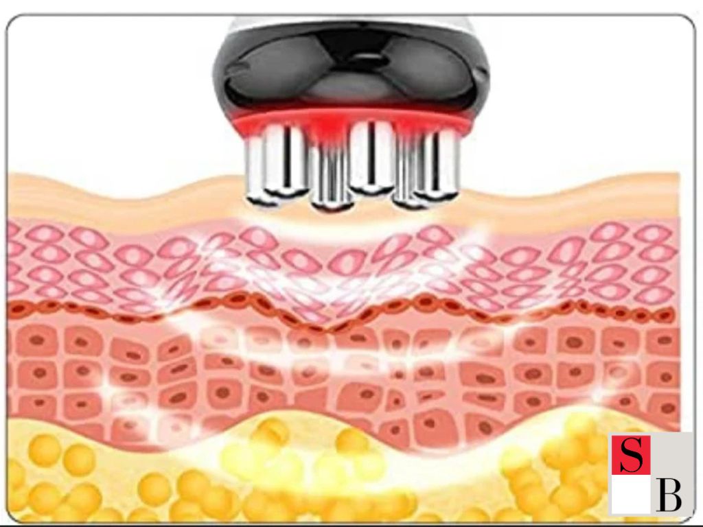 What Are Advanced Radiofrequency Treatments?