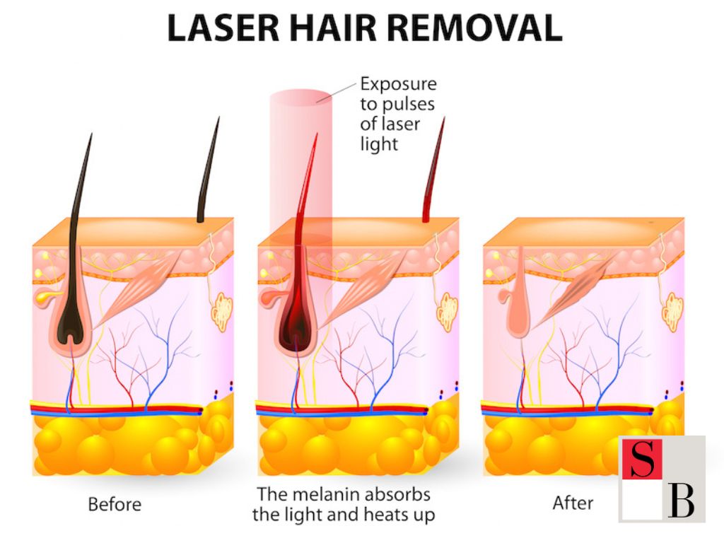 Understanding Laser Hair Removal and Asian Skin in Singapore