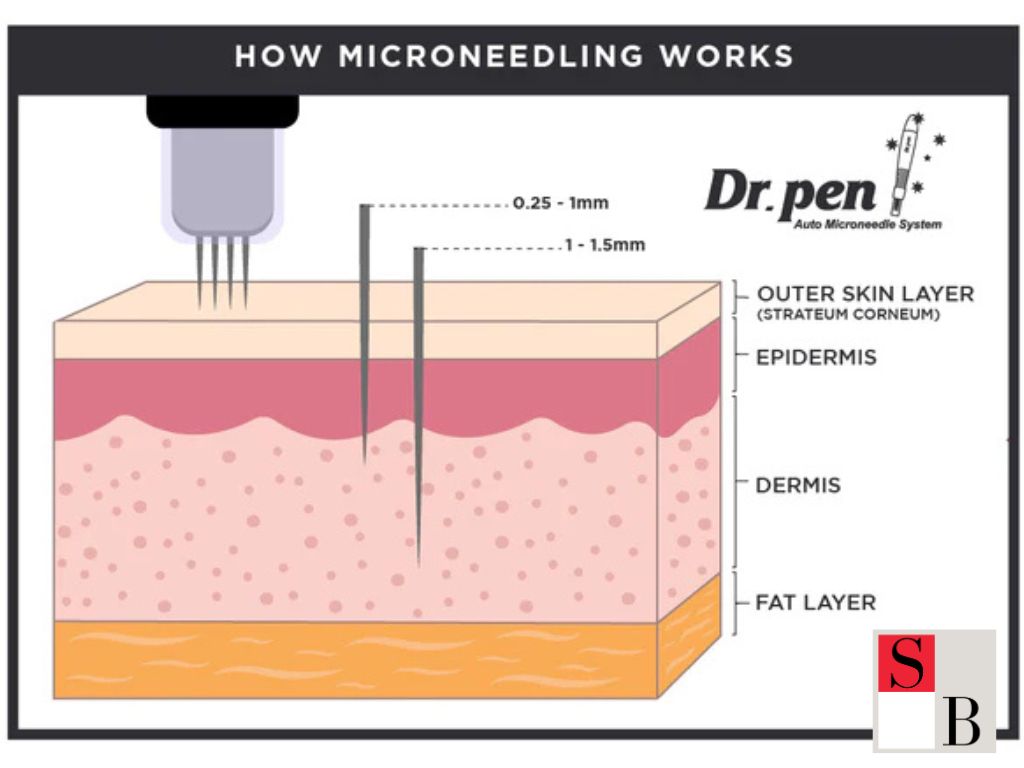What is Microneedling for Acne Scars in Singapore?