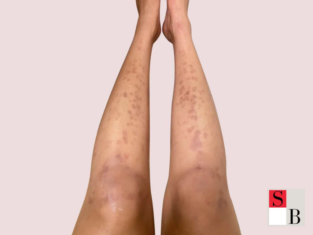 Why Laser Hair Removal Might Not Work for Asian Skin in Singapore