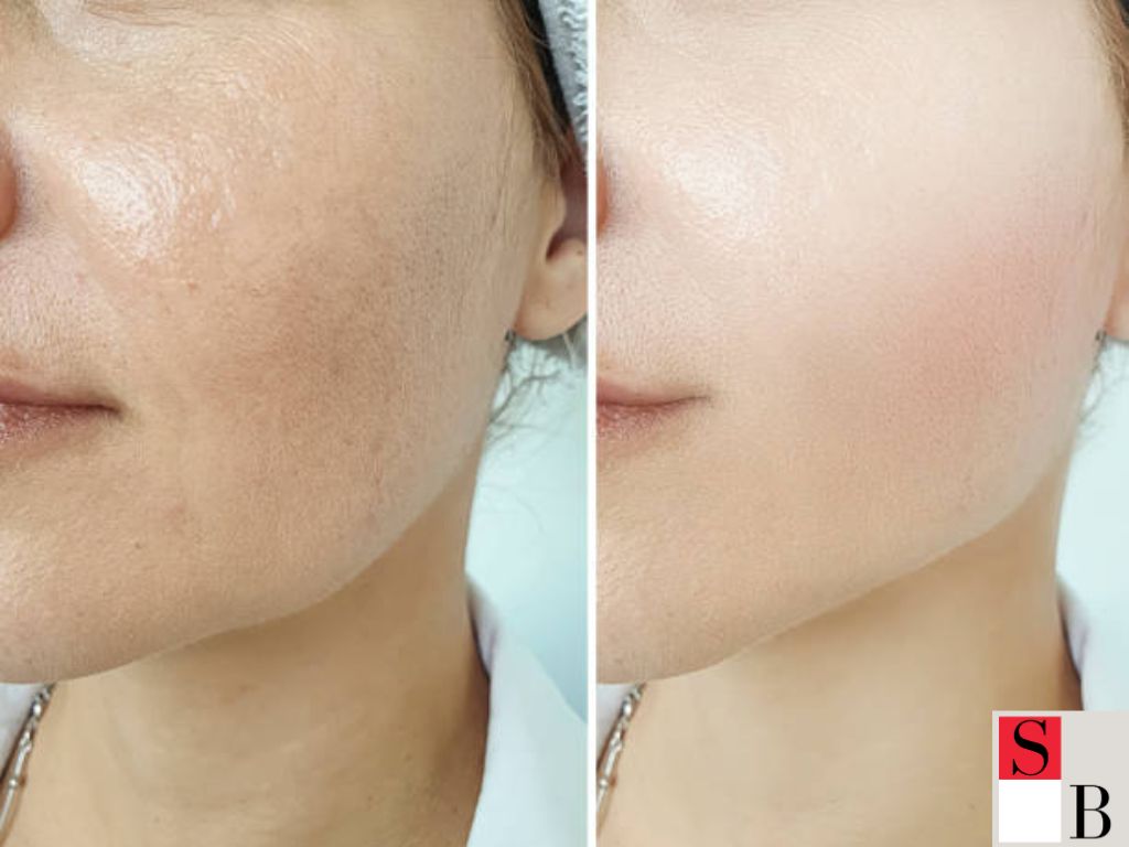 Benefits of Hydrating Facials for Singaporean Skin