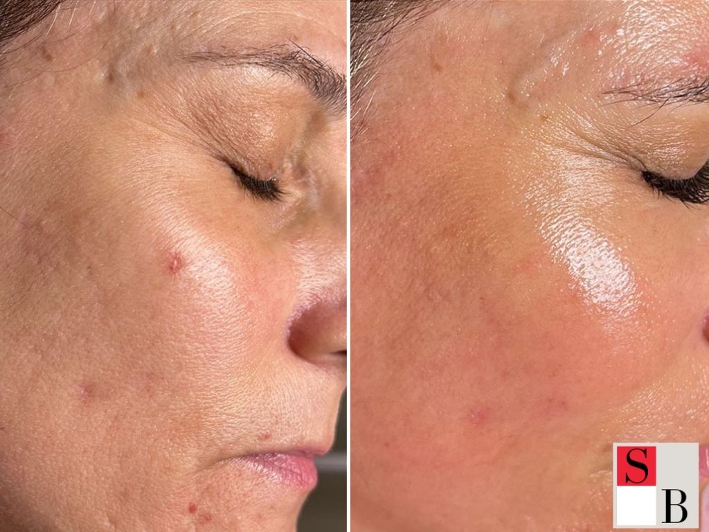 Practical Microneedling Aftercare Tips for Singaporeans