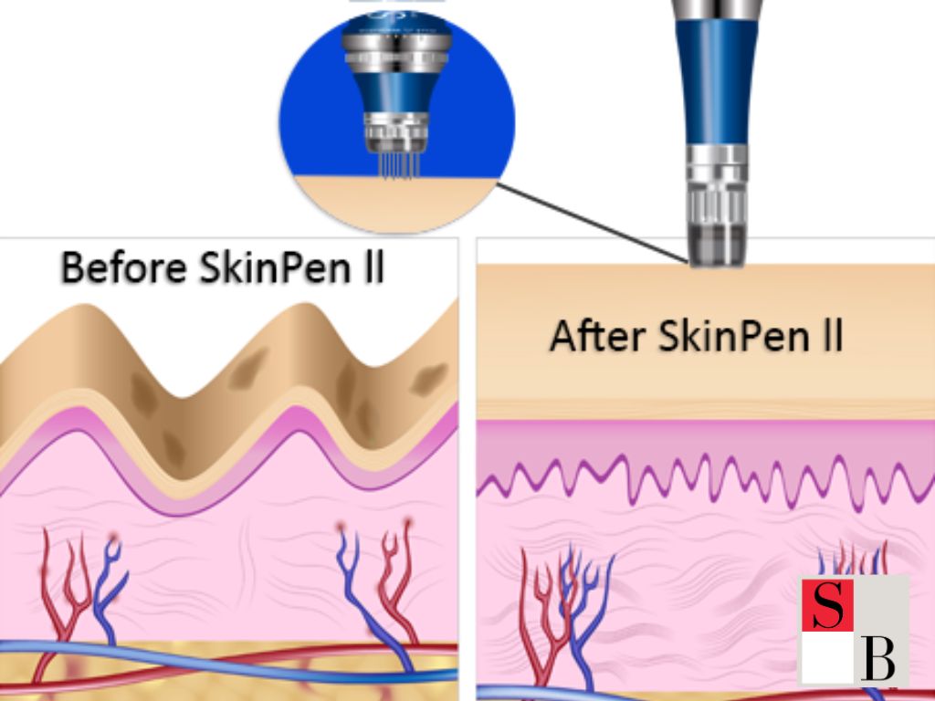 The Real Benefits of Microneedling for Acne Scars in Singapore