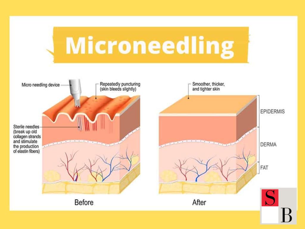 Microneedling Explained: The Modern Alternative to Traditional Facials