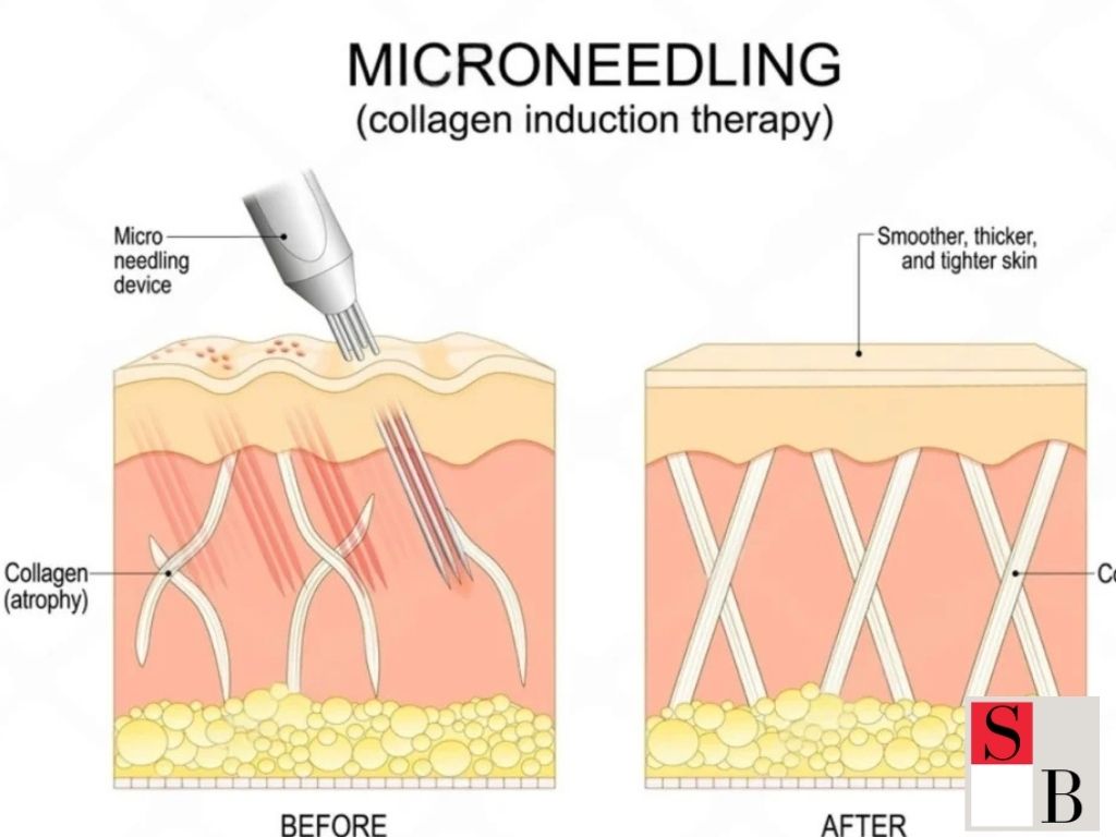 How to Safely Start Microneedling in Singapore