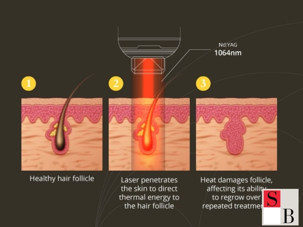 Making Smart Choices for Laser Hair Removal in Singapore