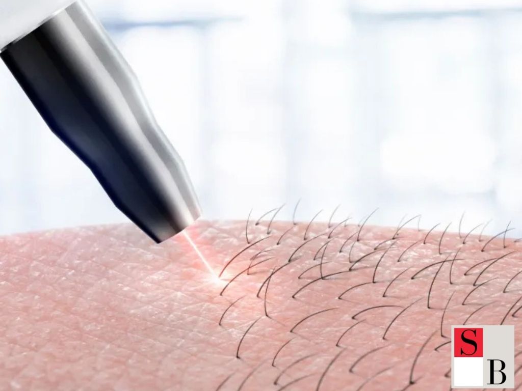 The Science Behind Laser Hair Removal for Southeast Asian Skin