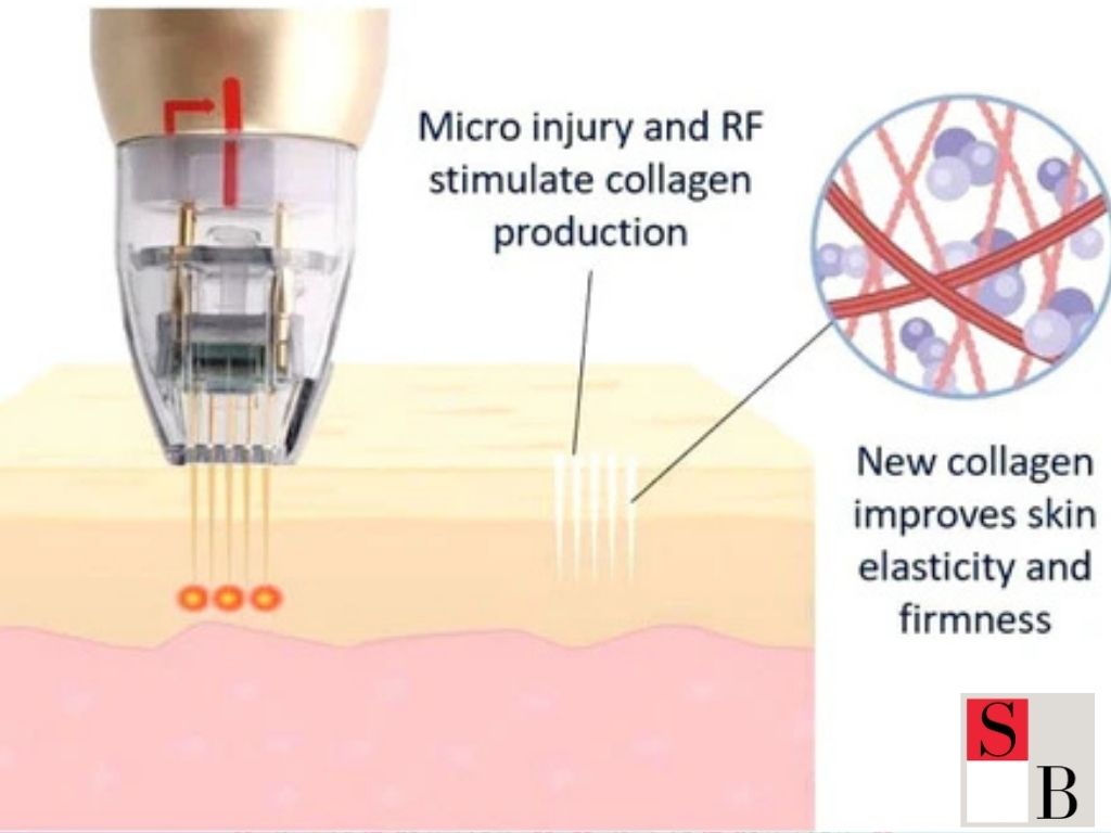 Understanding RF Microneedling for Mature Skin in Singapore
