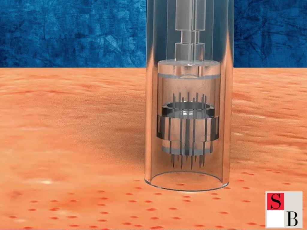 What Is Microneedling and Why It’s Gaining Ground in Singapore