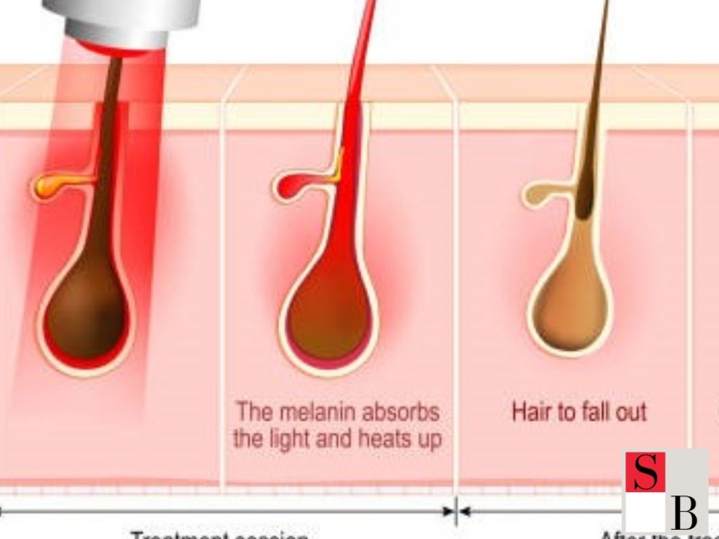 What is SHR Hair Removal in Singapore