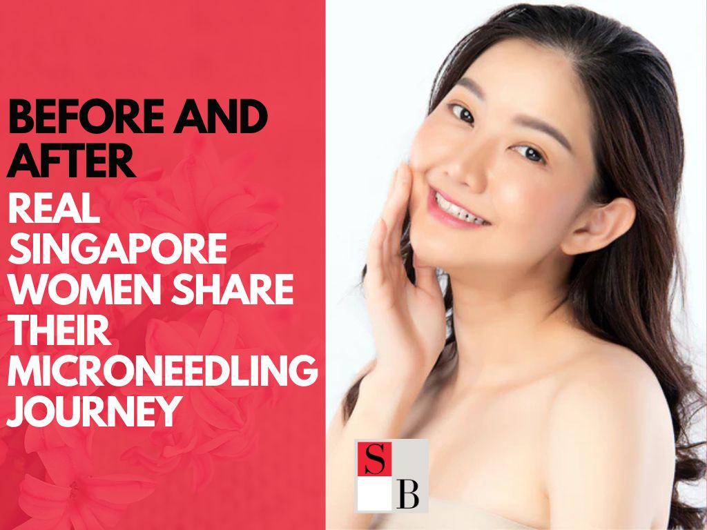 Before and After: Real Singapore Women Share Their Microneedling Journey