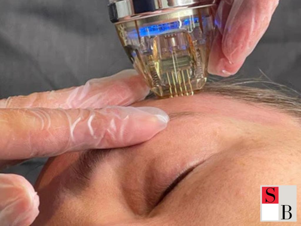 Professional Aesthetic Care: Why Wellaholic’s Gold RF Microneedling Leads in Singapore