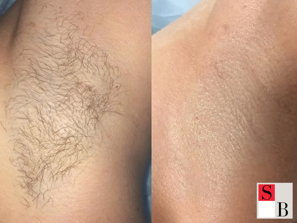 Making Hair Removal Work for You in Upper Changi
