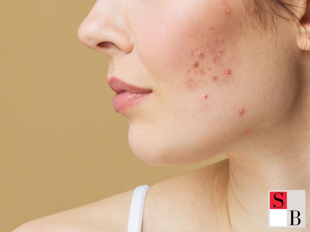 Why Your Skin Breaks Out During Chinese New Year and How to Prevent It