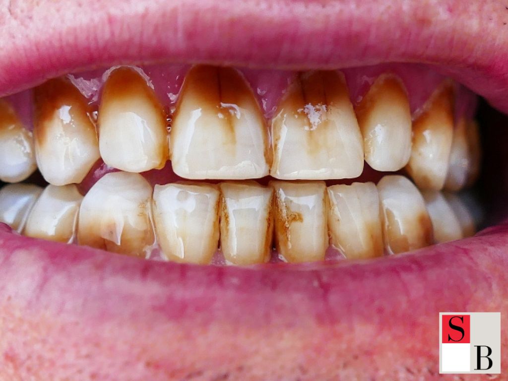 Understanding Coffee-Stained Teeth in Singapore