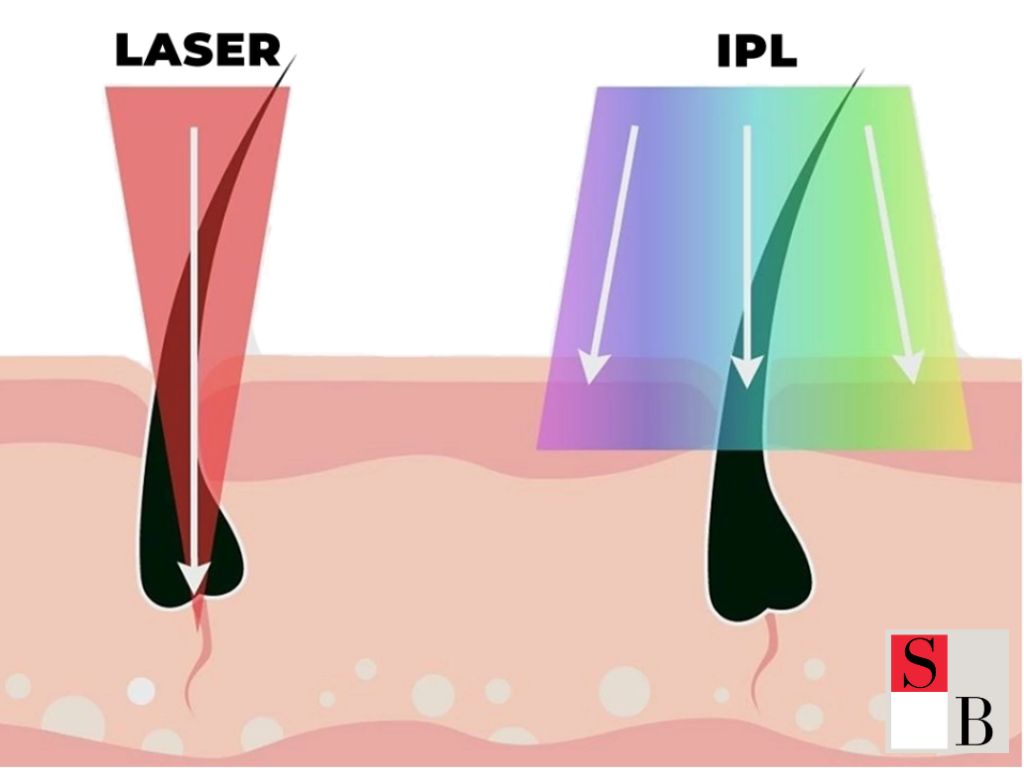 What Makes SHR Hair Removal the Preferred Choice in Singapore