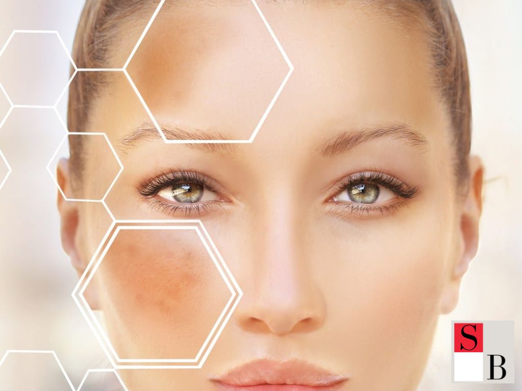 Elight Facial Results: What Singapore Women Can Expect
